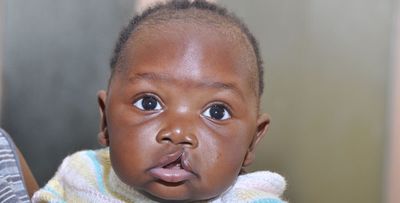 Cleft Lips and Palates: Facts, Myth, Mystery The Sunrise Newspaper