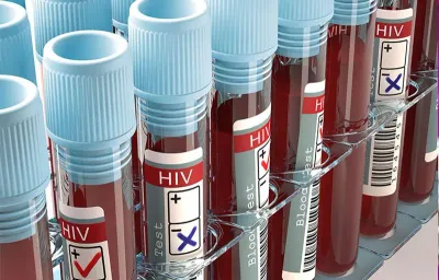 HIV Cases in Mityana Double, Health Officials Sound Alarm