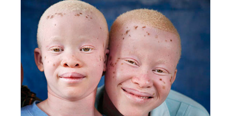 Albinos are the most marginalised groups in Uganda