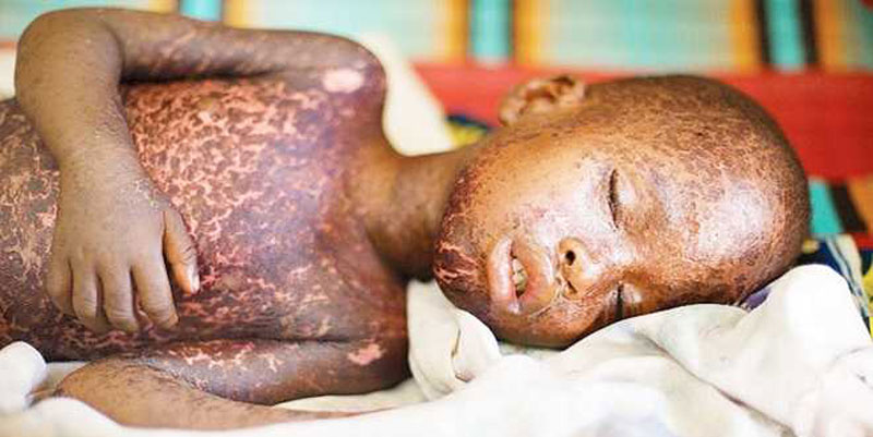 A child who has been scalded by German measles